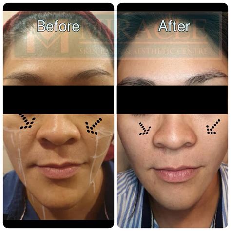 sagging miracle skin laser aesthetic centre