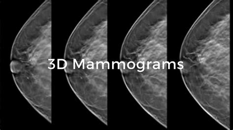 3d mamograms breast tomosynthesis breast cancer school for patients
