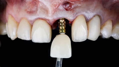 ramsey dental implants ramsey dental spa
