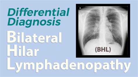 Bilateral Hilar Lymphadenopathy Bhl Differential Diagnosis Youtube