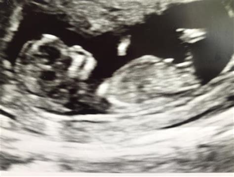 12 2 Nub Theory Need Guesses Update In Ultrasound Gender Prediction