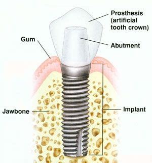 parts   dental implant implants consist   actual implant  fixture