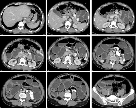 bowel obtruction  tumour radiology cases