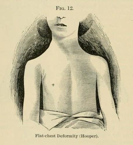 flat chest deformity arallyn flickr