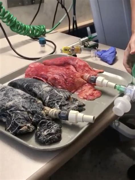 nurse reveals gruesome reality of what smokers lungs