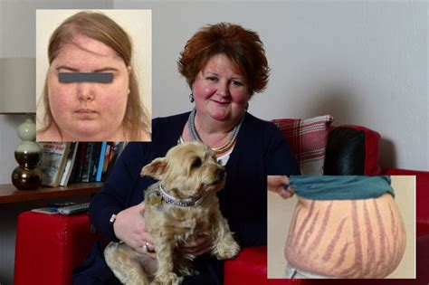 Syndrome Nicknamed Ugly Disease Left Scottish Woman With A Round Face