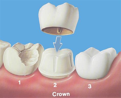 dental crowns  charlotte cosmetic dentist information