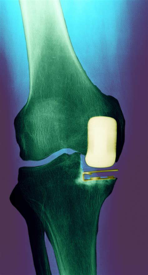 Partial Knee Replacement Surgery For Part Of The Joint