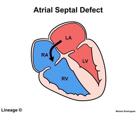 atrial septal defect asd cardiovascular medbullets step