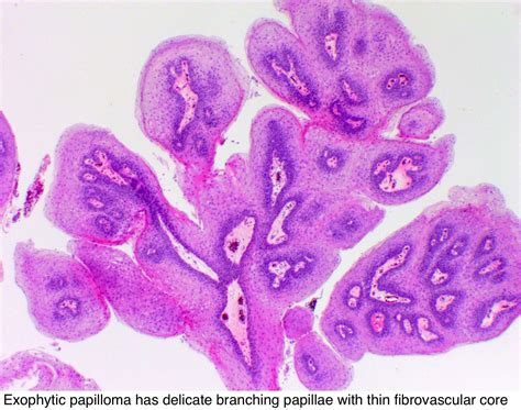 pathology outlines sinonasal papilloma