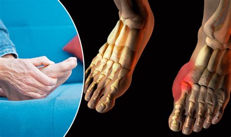 gout symptoms treatment and diet foods to avoid and what