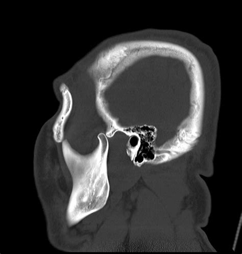 temporomandibular joint dislocation bilateral image