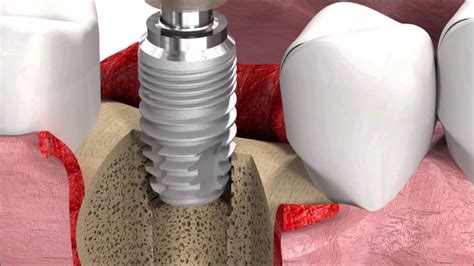 dental implantology standard surgery animation sicmax implant insertion youtube