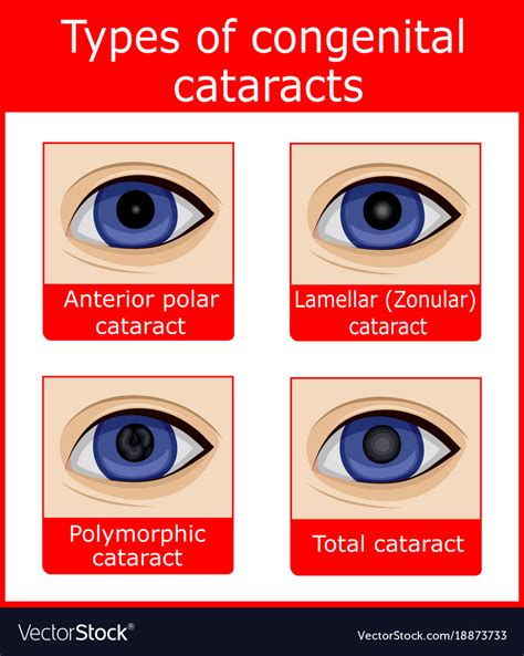 types of congenital cataracts royalty free vector image