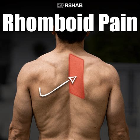 rhomboid pain  rehab