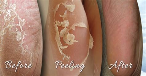home remedies for peeling skin on your feet top 5 diy