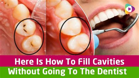 clean teeth cavity      cavity cranford dental