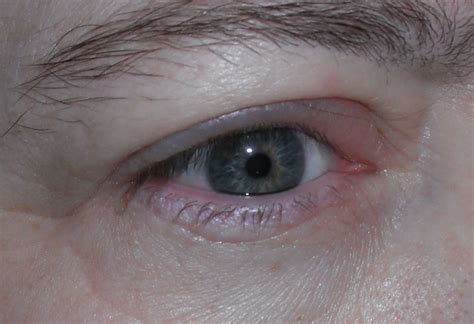 eye infection teresa trimm flickr