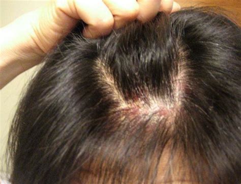itchy scalp symptoms hair loss  treatment hubpages