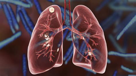 lung nodules northwestern medicine