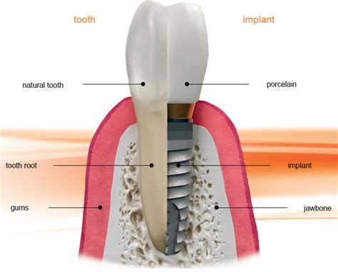 dental implants somerset dental implant clinic