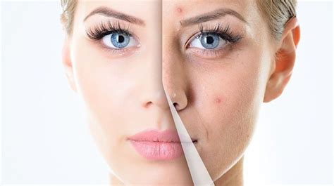 acne treatment    options  health science journal