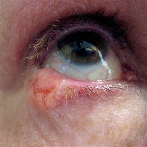 basal cell carcinoma   eyelid