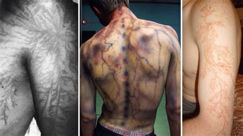 19 People Who Survived Getting Struck By Lightning Show What It Does To