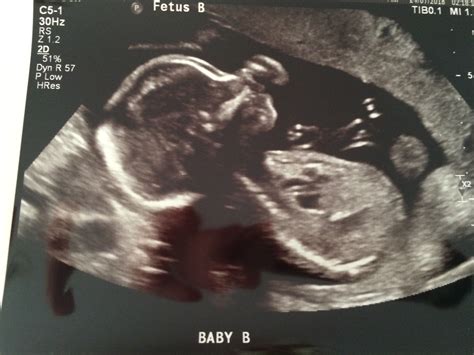 weeks ultrasound  twiniversity