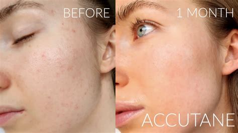 month accutane journey progress  mild acne side effects