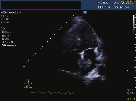 tte transthoracic echocardiogram showing  pedunculated mass  left  scientific