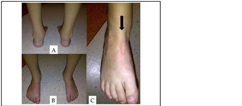 Lateral Intra Articular Transposition Of The Anterior Tibialis Tendon