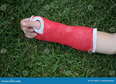 red wrist arm  hand cast royalty  stock image image