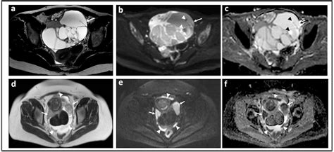 jcm  full text diffusion weighted magnetic resonance imaging  ovarian cancer
