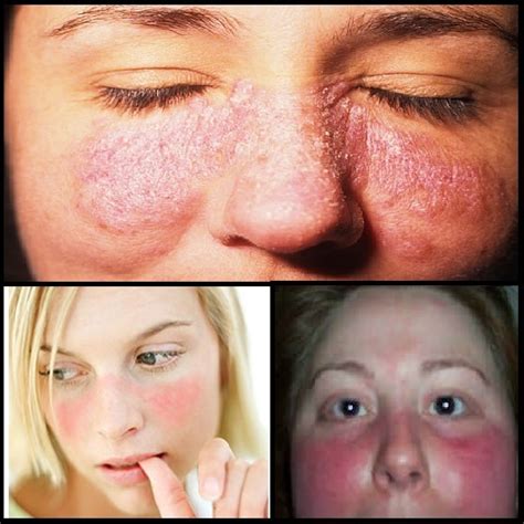lupus rash types effects diagnoses treatments prevention