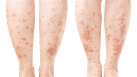 psoriasis caused by genetics external triggers fox news
