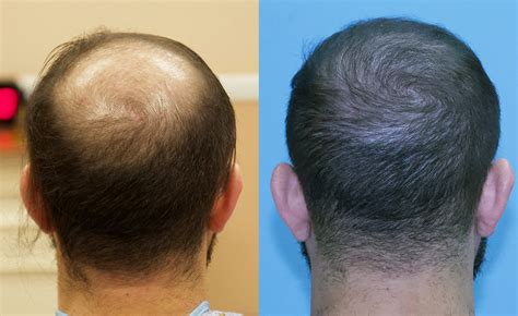 fast results   fue grafts transplanted carolina hair surgery