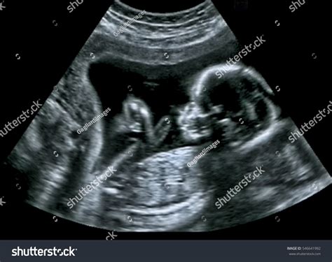 ultrasound baby images browse  stock  vectors