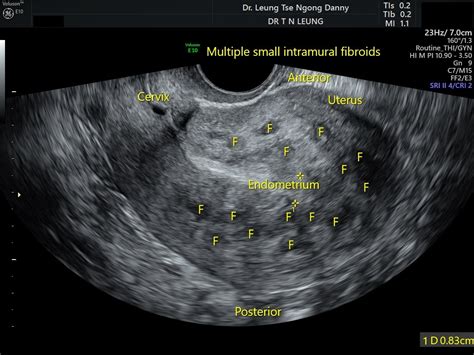 uterine fibroid leiomyoma hkog info