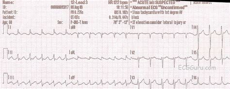 10 Tips To Never Miss Atrial Flutter With 2 1 Conduction