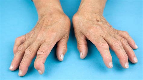 early treatment best for rheumatoid arthritis nz
