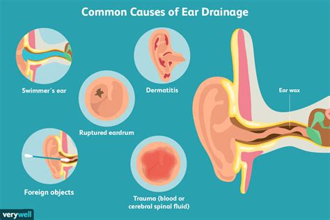 Causes And Treatment For Ear Drainage