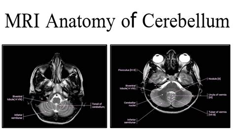 mri anatomy  cerebellum youtube