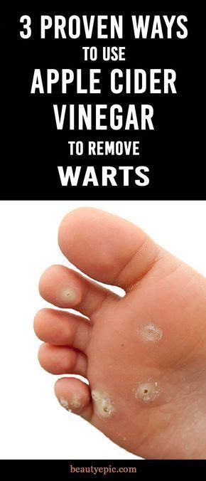 3 proven ways to use apple cider vinegar to remove warts
