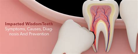 impacted wisdom teeth symptoms causes diagnosis and prevention