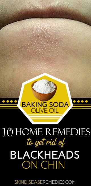 how to get rid of blackheads on chin 10 diy remedies