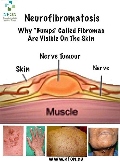 pin by annah norberg on nf neurofibromatosis type 1