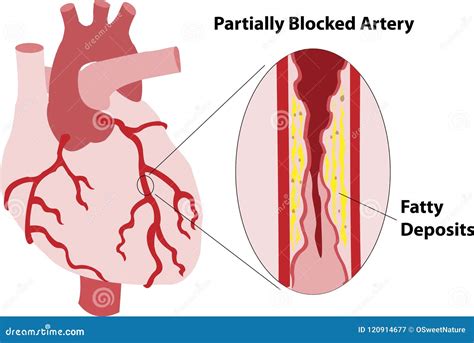 partially blocked coronary artery stock image illustration  blocked
