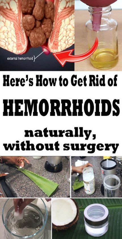get rid of hemorrhoids naturally hemorrhoids homeremedy