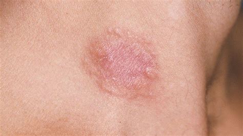 Leukemia Rash Pictures Signs And Symptoms